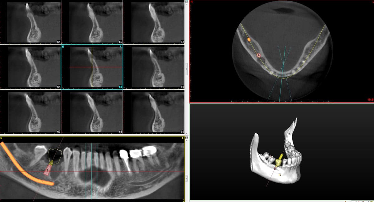 Porcelain Crowns