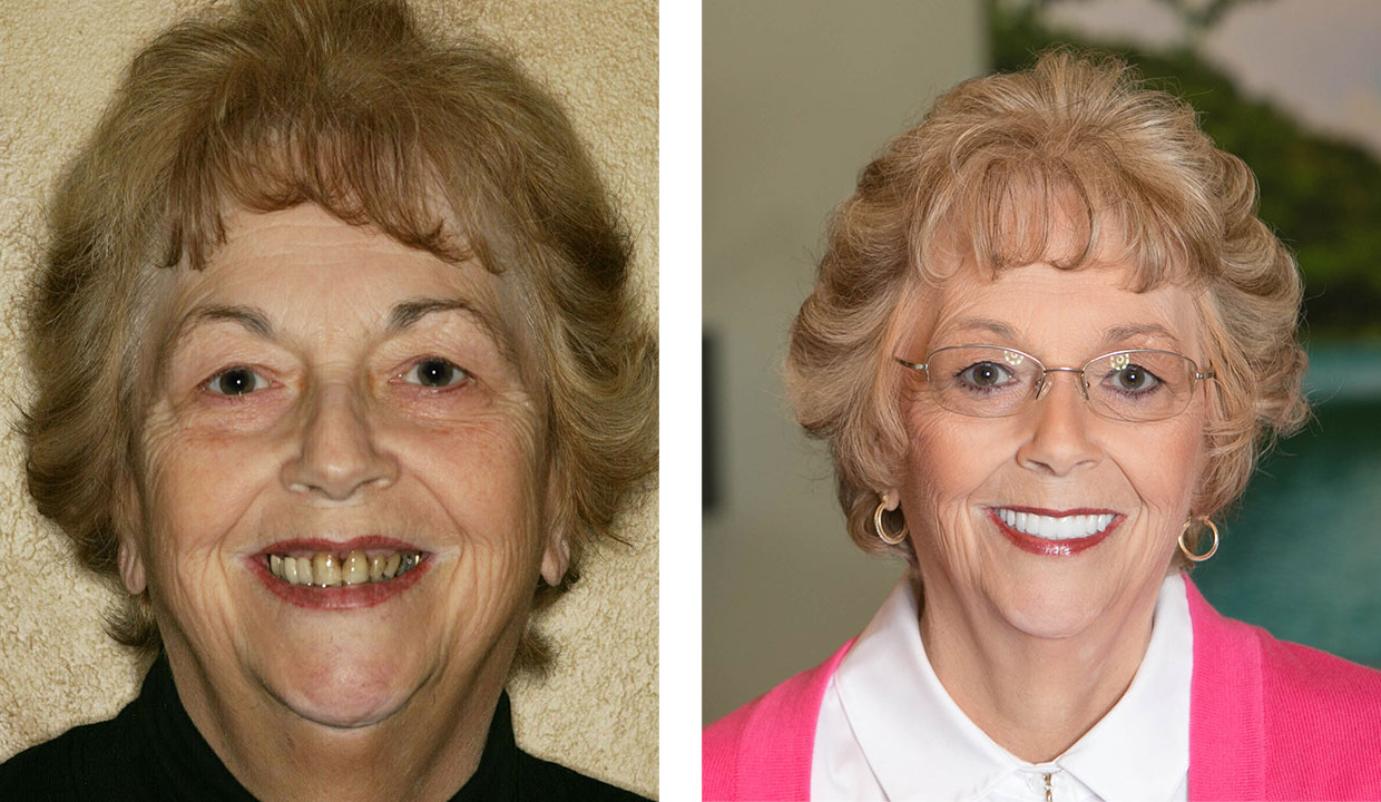before and after photo of patient with dental implants