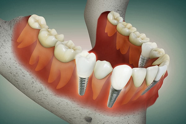 Multiple Tooth Implant illustration