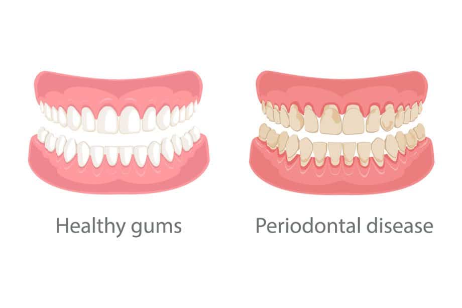 What Causes Gum