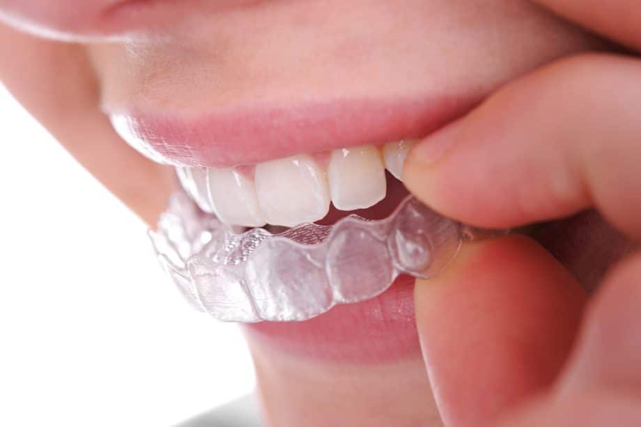 How Long Does It Take For Invisalign To Work?