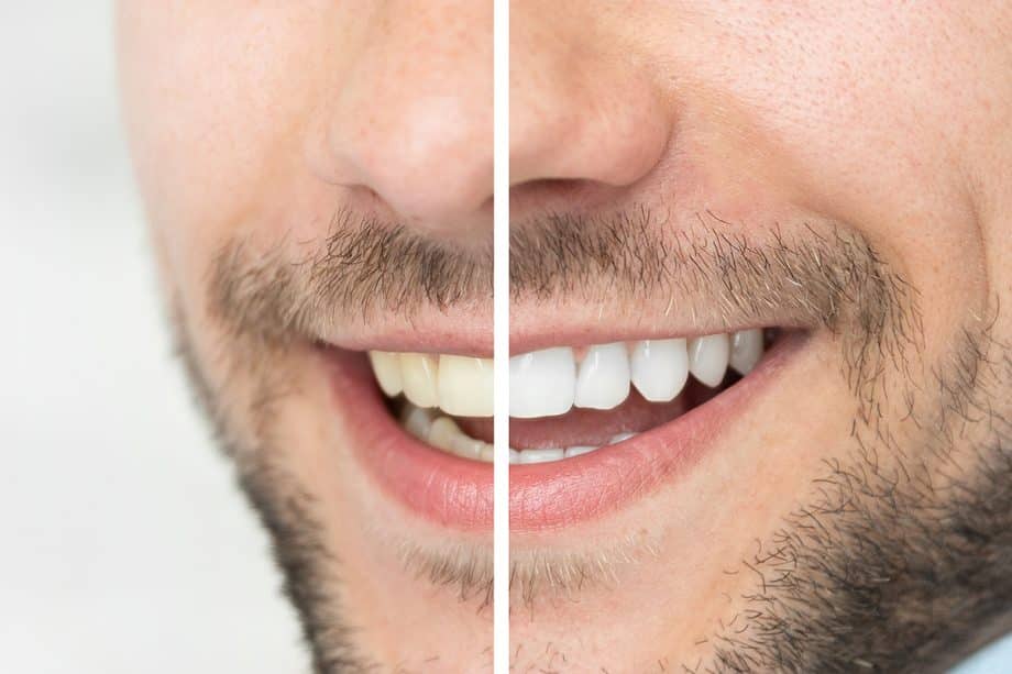 What is the Cost of Teeth Whitening in Bentonville, AR?
